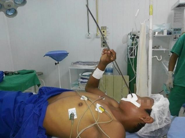 Un pescar a ajuns la spital cu o sageata infipta in cap, dupa ce a fost confundat cu un peste