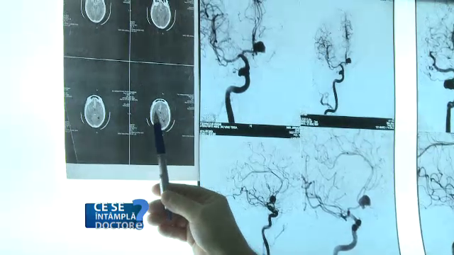 Alertati-va daca pupilele sunt inegale. Poate fi semnul unor afectiuni grave. Care sunt acestea