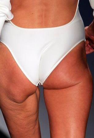 Plina de celulita si cu pielea atarnand. Vezi cine a fost surprinsa asa FOTO