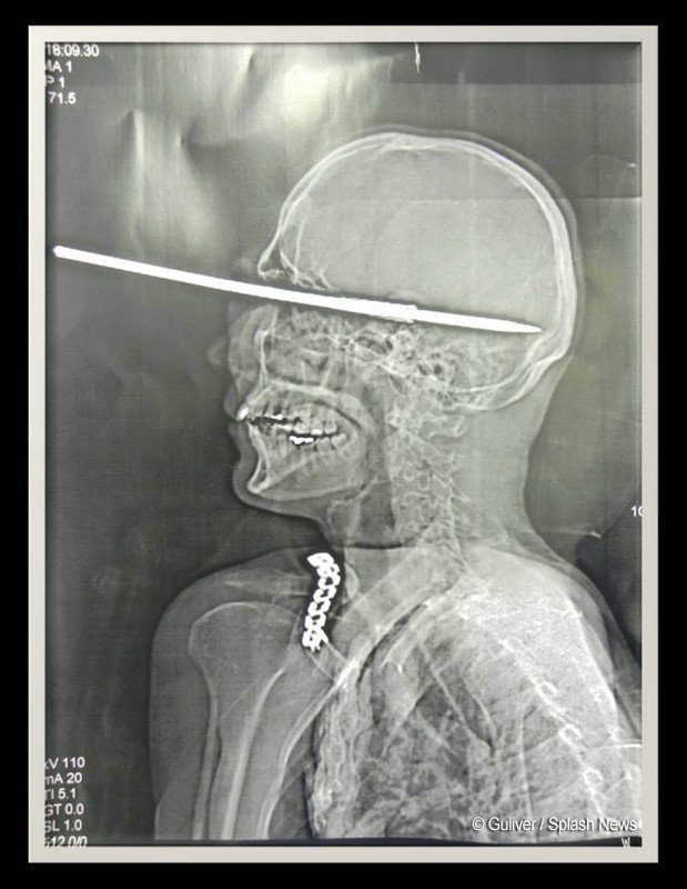 Medicii au ramas fara cuvinte cand au vazut radiografia unui barbat: "Nu stim cum a scapat cu viata"