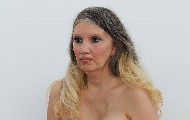 "Ma simt ca un monstru". O operatie de marire a sanilor a desfigurat-o intr-un mod greu de inchipuit