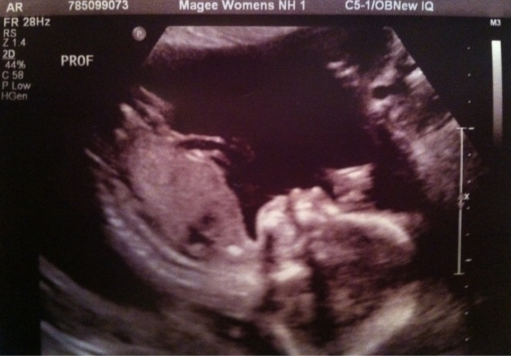 Medicii au scos din abdomenul unei femei scheletul unui bebelus, dupa 38 de ani