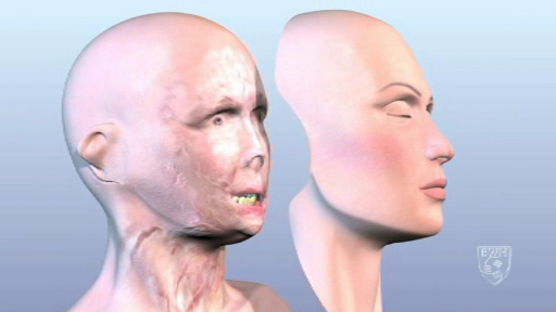 O femeie, desfigurata de fostul sot, a iesit prima data in public dupa un transplant de fata