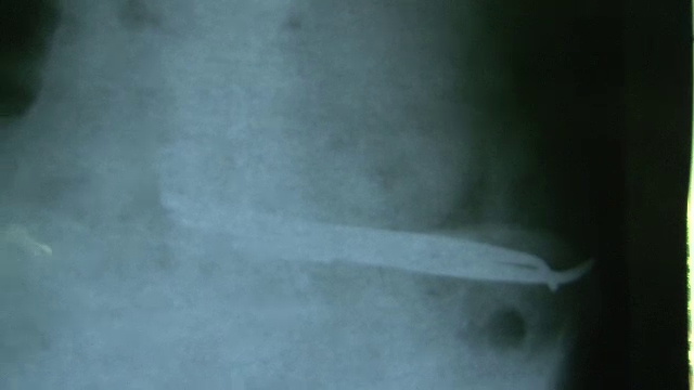 Concluzia anchetei in cazul pacientului care a stat 3 ani cu foarfece uitate in stomac