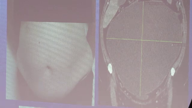 Femeia din Constanta care avea o tumoare de 20 de kg in loc de sarcina a fost operata cu succes