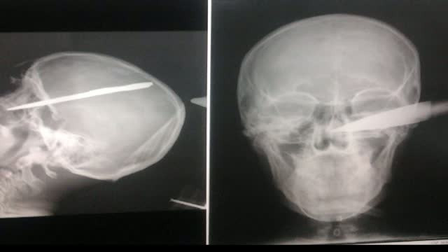 Povestea unui miracol. Cum a supravietuit un tanar de 20 de ani din Bucuresti cu sabie in craniu