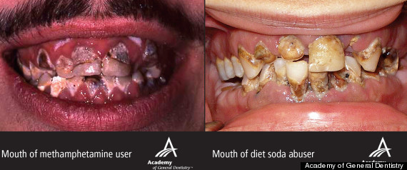 Studiu: Sucurile dietetice au acelasi efect asupra dintilor ca metamfetaminele si cocaina