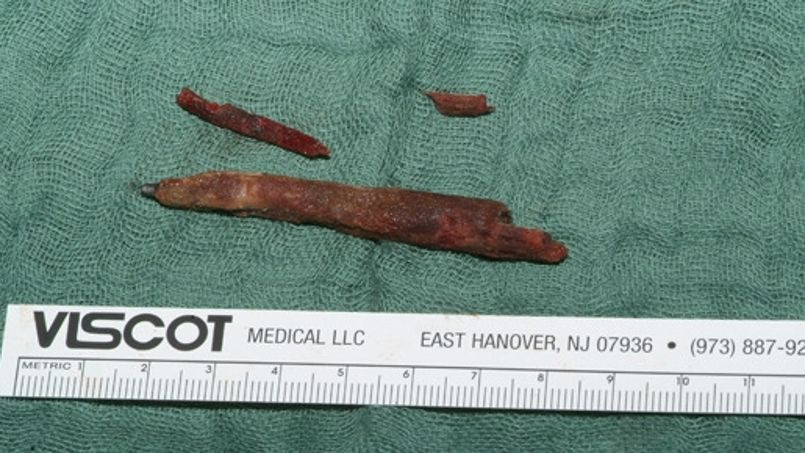 Medicii germani, stupefiati dupa ce au gasit un creion in capul unui tanar de 24 de ani