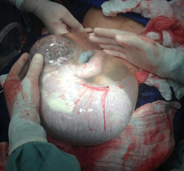 Experienta unica traita de un medic. Bebelus adus pe lume, aflat inca in sacul amniotic intact. FOTO