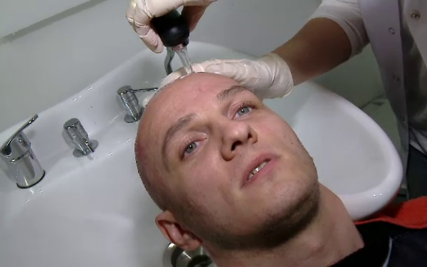 Vestea pe care a primit-o Mihai Traistariu de la medicul ce i-a facut implantul de par