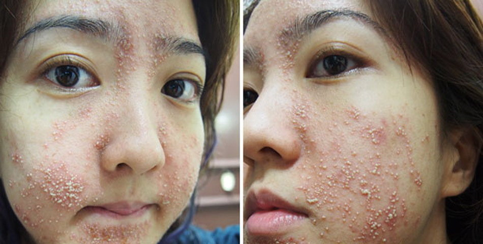 tratament cosmetic ratat - 6