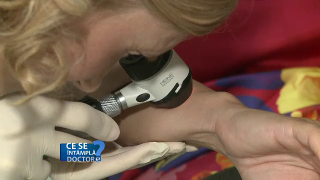 Stati la soare doar in orele sigure. Cum reduceti riscul de aparitie a cancerului cutanat