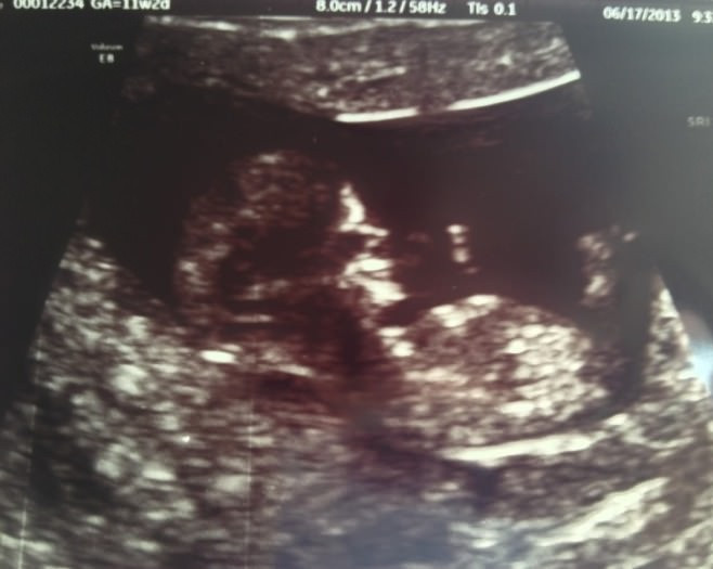 Ecografia pe care nu s-a putut abtine sa nu publice pe internet. Ce se vede in imagine