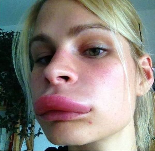 botox
