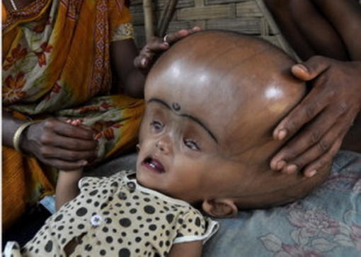 "Incercam sa-i redam chipul uman". Cum arata copilul "extraterestru", ACUM, dupa trei operatii. FOTO