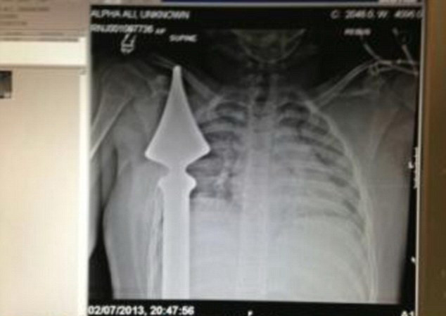 Doctorii au inghetat cand au vazut radiografia. "Am crezut ca asistam la un film de groaza"