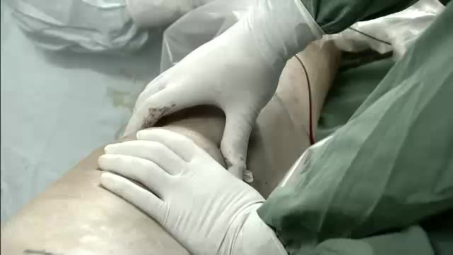 Un chirurg şi-a scris iniţialele cu laser pe ficatul pacienţilor pe care i-a operat