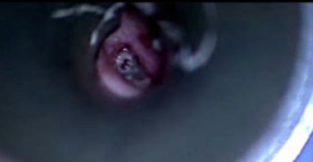 Medicul credea ca tanara are o infectie la ureche. Cand s-a uitat mai atent a amutit. Ce a vazut