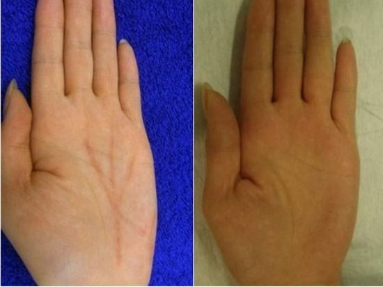 Tot mai multi japonezi isi fac operatii estetice la palme. Motivul bizar pe care il invoca. FOTO