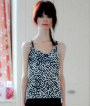 "Inima mea s-a oprit. Am murit". Cum arata acum aceasta tanara dupa ce a invins anorexia