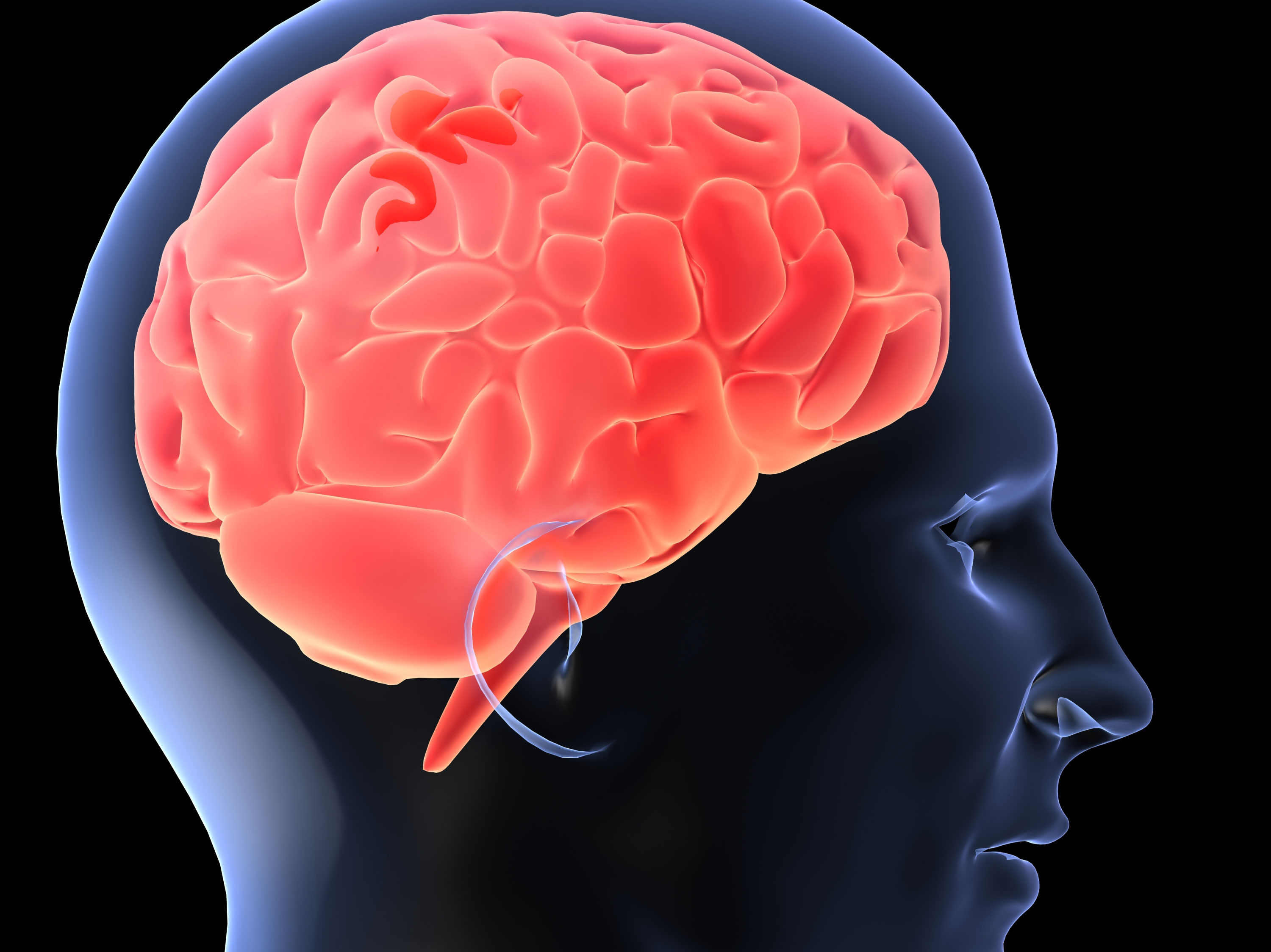 Studiu: Stangacii au sanse mult mai mari sa sufere de boli mintale, printre care si schizofrenia