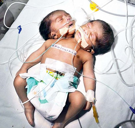 Un copil cu doua capete s-a nascut in India. Medici: Speram sa gasim o solutie si sa traiasca. VIDEO