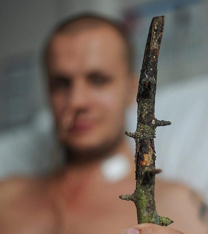 Si-a vazut moartea cu ochii. O ramura i-a sectionat vena jugulara si i-a ramas infipta in gat