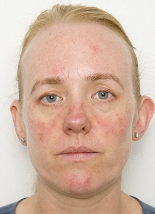 A acceptat experimentul unor dermatologi. Dupa o luna de zile, nu s-a recunoscut in oglinda. FOTO