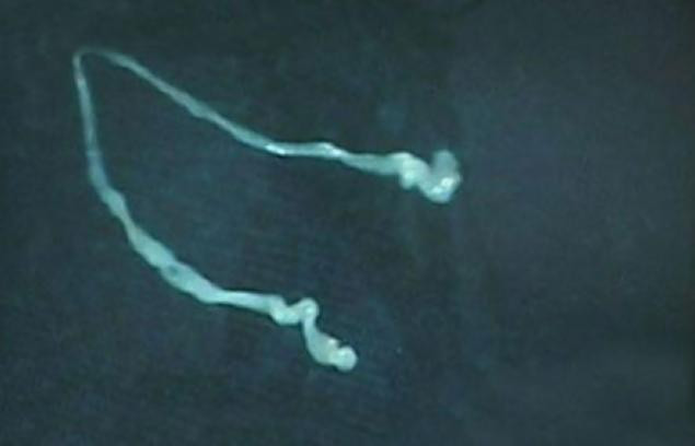 "Cum a ajuns asta acolo?" Ce au vazut medicii pe radiografia unui barbat care se plangea de migrene