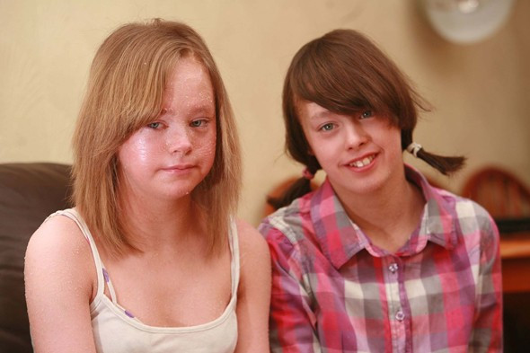 Surorile cu "piele de sarpe". Boala care le face sa piarda 25 de kg de piele in fiecare an