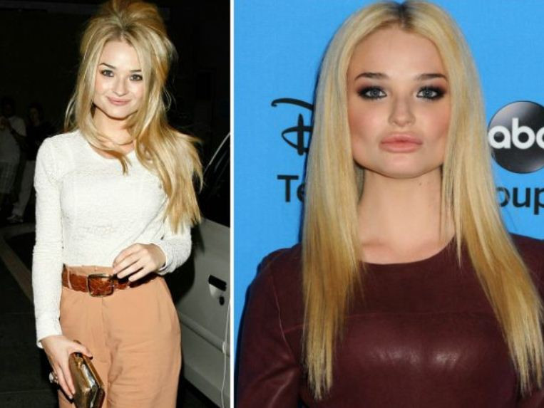 O vedeta britanica si-a deformat chipul pentru ca si-a dorit buze mai mari