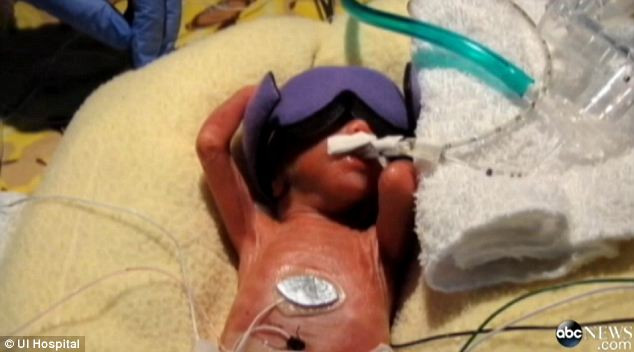 Medicii nu i-au dat nicio sansa. Ce s-a intamplat cu copilul care avea 507 gr la nastere