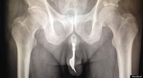 radiografie, furculita in penis