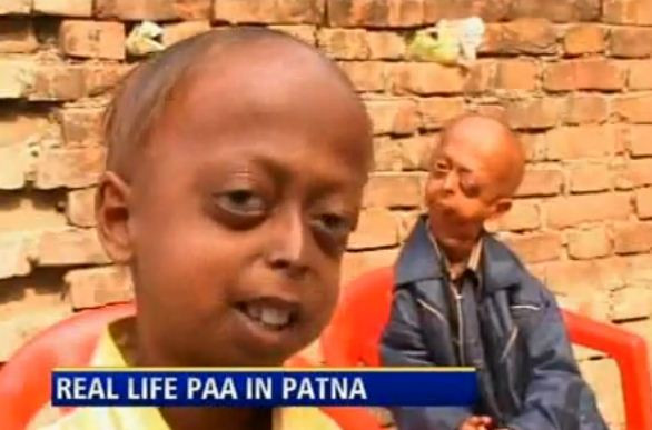 La 14 ani, Ali Hussain arata ca un bunic de 70 de ani. Sunt 80 de astfel de cazuri in lume