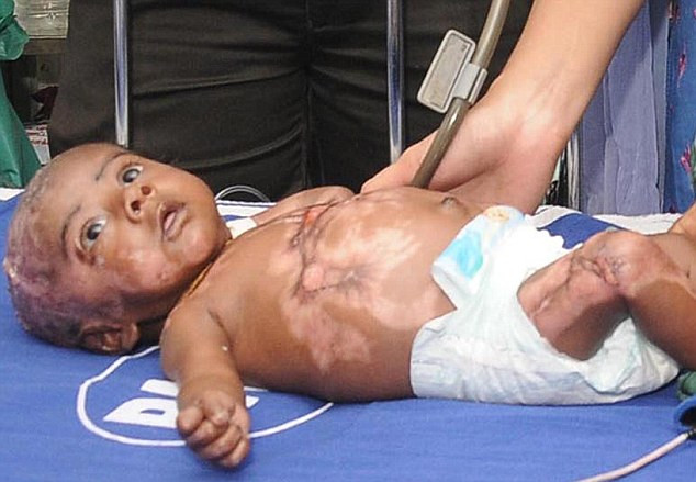 Cazul uimitor al unui bebelus din India care arde singur. Explicatia medicilor: acetona din corp