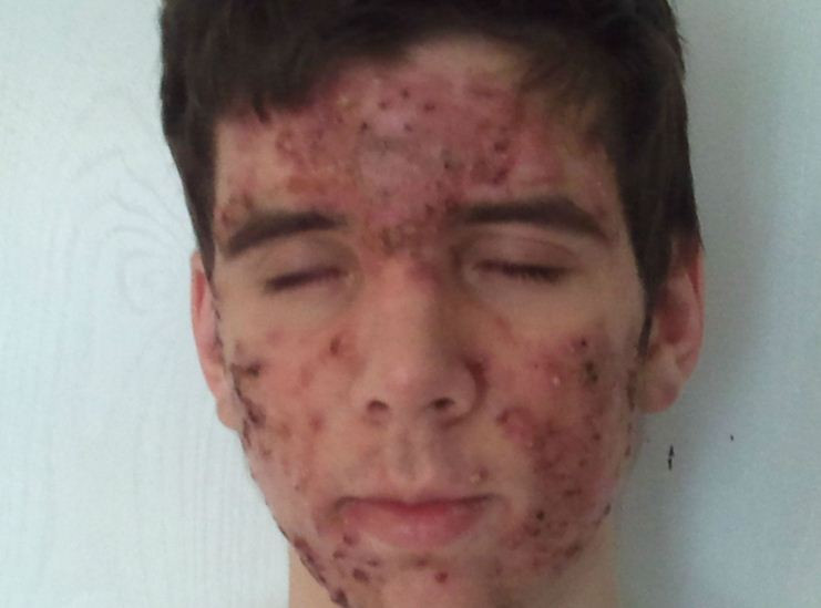 "Mi-era groaza sa ma uit in oglinda". Cum s-a transformat un tanar afectat de acnee