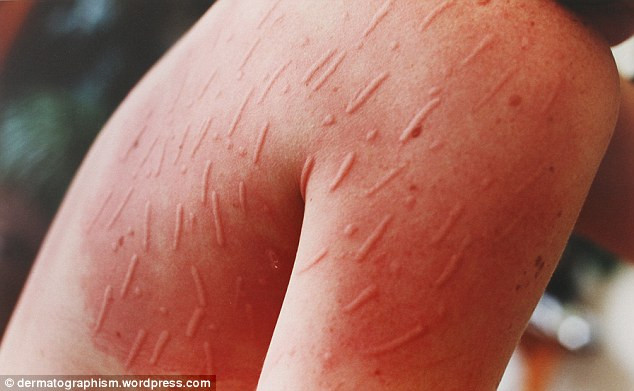 Creeaza arta pe propria piele. Cum se foloseste o tanara de boala incurabila de care sufera