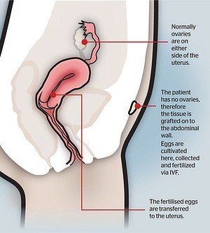 ovare