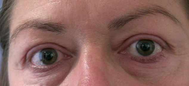 "Aratam ca o broasca". Femeia care a ramas complet fara gene din cauza extensiilor