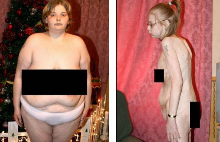 De la supraponderala la anorexica. Povestea unei tinere in pericol sa isi piarda viata