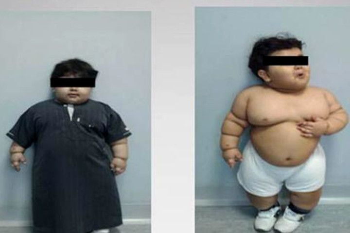 Cea mai tanara persoana din lume operata de obezitate. Cum arata acest acopil acum