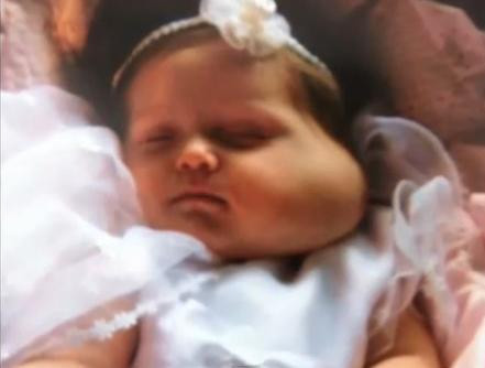 bebelus cu hemangiom