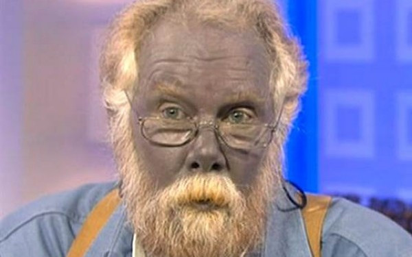 INCREDIBIL! Ce s-a intamplat cu singurul om din lume cu PIELEA ALBASTRA