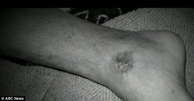 Un barbat care s-a trezit cu aceasta leziune minora la picior a murit in 28 de ore. Ce s-a intamplat