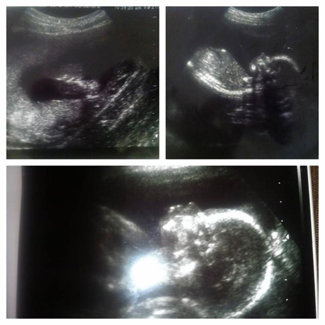 Un copil din Florida s-a nascut prin cezariana, dupa ce mama sa a fost impuscata mortal