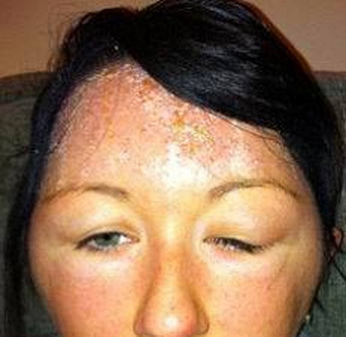 Toate femeile folosesc asta, dar pe ea a desfigurat-o. Ce produs cosmetic i-a provocat reactia