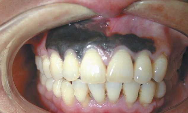 I s-au innegrit gingiile. Boala extrem de rara de care sufera un chinez. FOTO