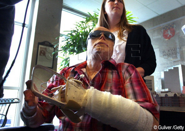 A fost complet desfigurat in urma unui incendiu, iar acum se casatoreste. Cum arata viitoarea sotie