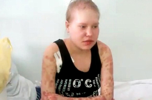 Efectele devastatoare ale drogului Krokodil. Femeia care e oarba si are cancer si HIV. FOTO