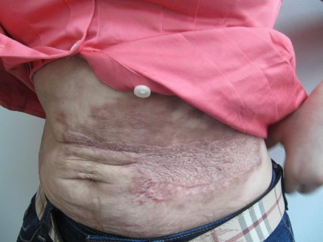 A fost desfigurata dupa o interventie estetica banala. Cum arata abdomenul femeii dupa liposuctie